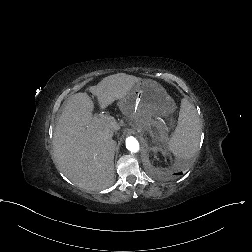 Active renal extravasation with large subcapsular and retroperitoneal hemorrhage (Radiopaedia 60975-68796 Axial C+ arterial phase 45).jpg