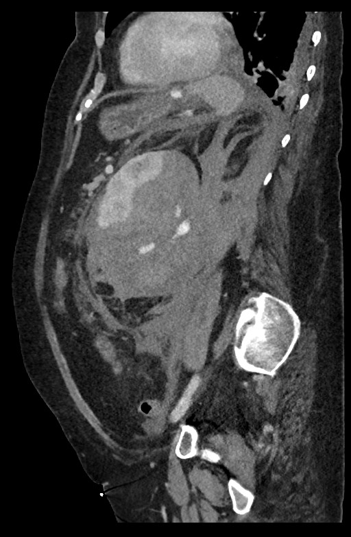 Active renal extravasation with large subcapsular and retroperitoneal hemorrhage (Radiopaedia 60975-68796 Sagittal C+ portal venous phase 85).jpg