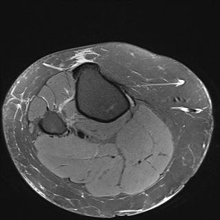 File:Acute-on-chronic transient lateral patellar dislocation with trochlear dysplasia (Radiopaedia 84099-99349 Axial PD fat sat 37).jpg