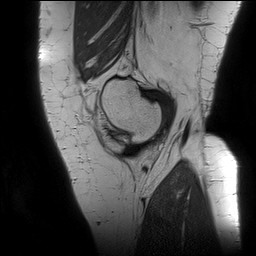 Acute-on-chronic transient lateral patellar dislocation with trochlear dysplasia (Radiopaedia 84099-99349 Sagittal PD 31).jpg