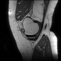 Acute-on-chronic transient lateral patellar dislocation with trochlear dysplasia (Radiopaedia 84099-99349 Sagittal PD 36).jpg