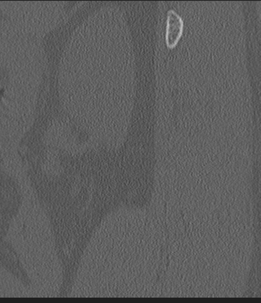 Acute L1 burst compression fracture (Radiopaedia 34430-35755 Sagittal bone window 2).png