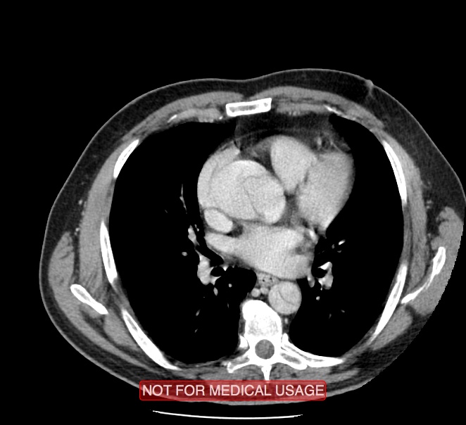 Acute aortic dissection - Stanford type A (Radiopaedia 40661-43285 Axial C+ portal venous phase 29).jpg