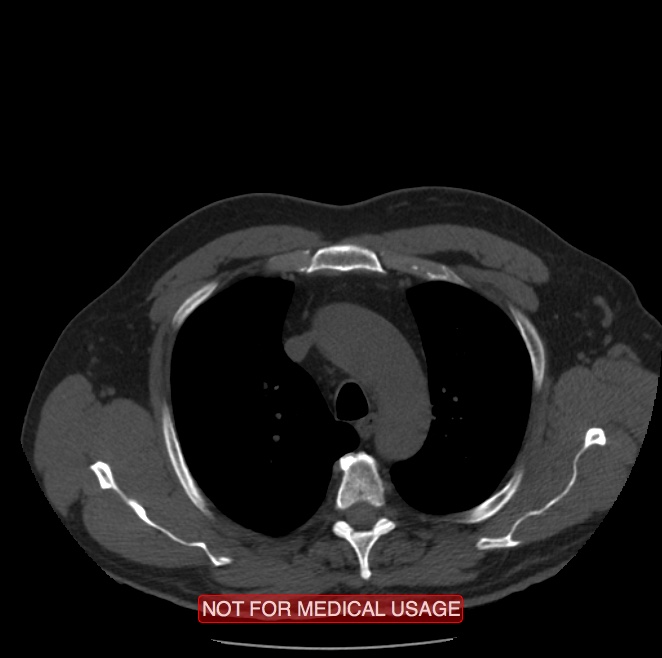 Acute aortic dissection - Stanford type A (Radiopaedia 40661-43285 Axial non-contrast 4).jpg