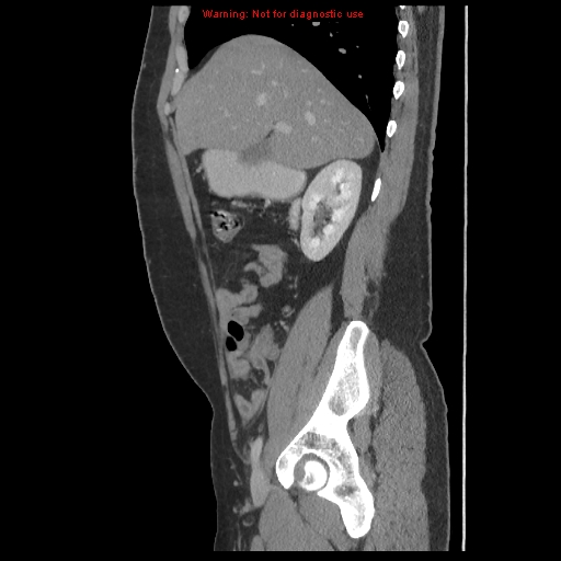 File:Acute appendicitis (Radiopaedia 10498-10973 Sagittal C+ portal venous phase 6).jpg