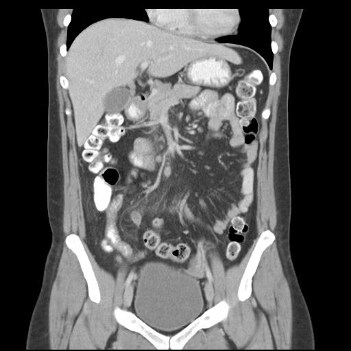 Acute appendicitis (Radiopaedia 30297-30934 Coronal C+ portal venous phase 19).jpg