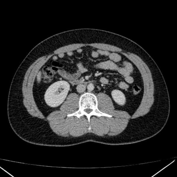 Acute appendicitis (Radiopaedia 38255-40270 Axial C+ portal venous phase 51).jpg