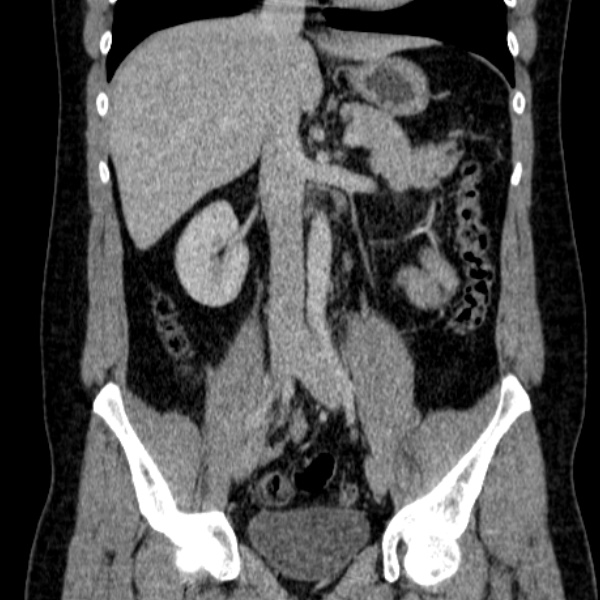 Acute appendicitis (Radiopaedia 38255-40270 Coronal C+ portal venous phase 45).jpg