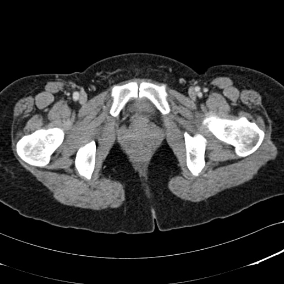 File:Acute appendicitis (Radiopaedia 48792-53822 Axial C+ portal venous phase 121).jpg
