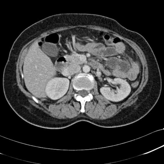 File:Acute appendicitis (Radiopaedia 48792-53822 Axial C+ portal venous phase 43).jpg