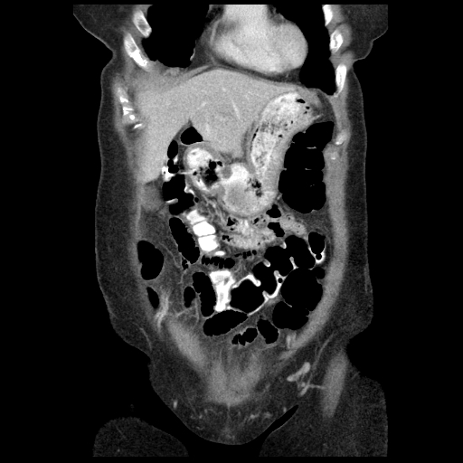 File:Acute appendicitis (Radiopaedia 52672-58589 Coronal C+ portal venous phase 7).jpg