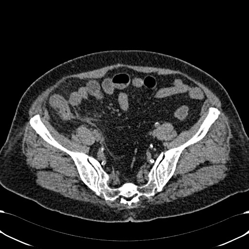 Acute appendicitis (Radiopaedia 58627-65818 Axial non-contrast 68).jpg