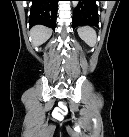 Acute appendicitis (Radiopaedia 77016-88960 Coronal C+ portal venous phase 77).jpg