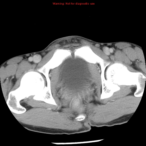 Acute appendicitis (Radiopaedia 8195-9045 Axial C+ portal venous phase 75).jpg
