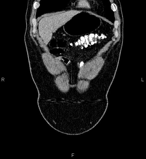 Acute appendicitis (Radiopaedia 84780-100240 Coronal C+ portal venous phase 8).jpg