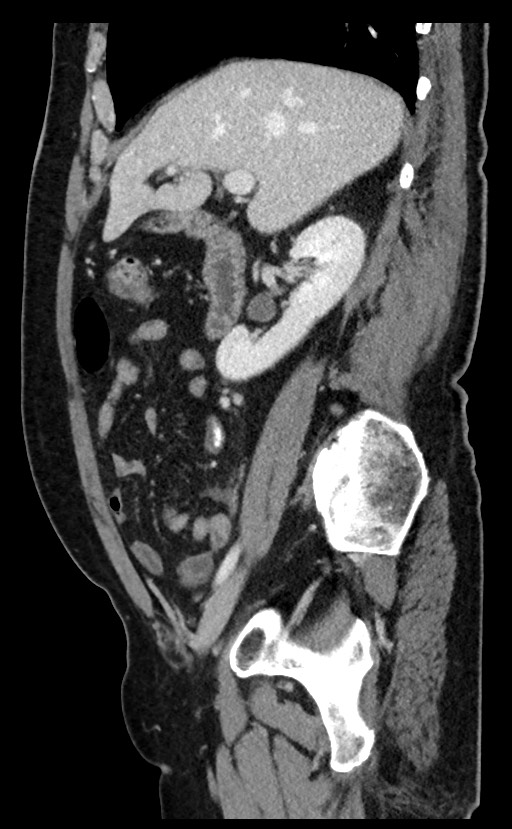 Acute appendicitis - large appendicoliths (Radiopaedia 61805-69820 Sagittal C+ portal venous phase 76).jpg