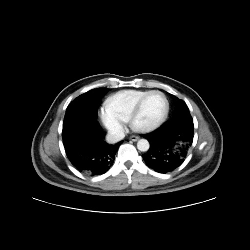 Acute appendicitis and COVID 19 pneumonia (Radiopaedia 76604-88380 Axial C+ portal venous phase 2).jpg