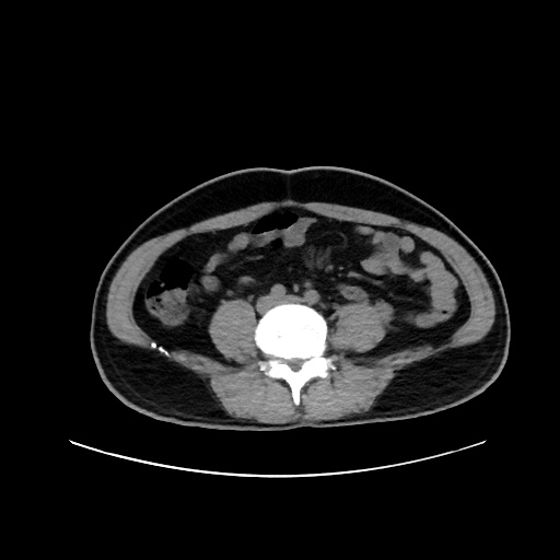 Acute appendicitis and COVID 19 pneumonia (Radiopaedia 76604-88380 Axial non-contrast 88).jpg
