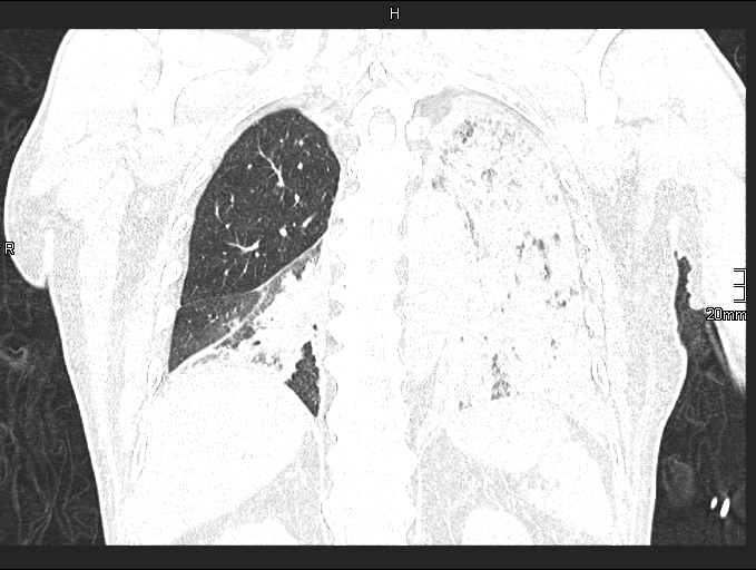 Acute aspiration pneumonitis (Radiopaedia 55642-62166 Coronal lung window 74).jpg