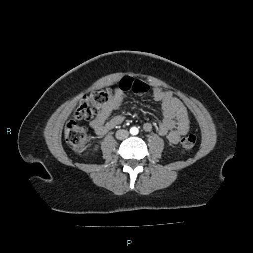 File:Acute bilateral pyelonephritis (Radiopaedia 37146-38881 Axial C+ arterial phase 113).jpg