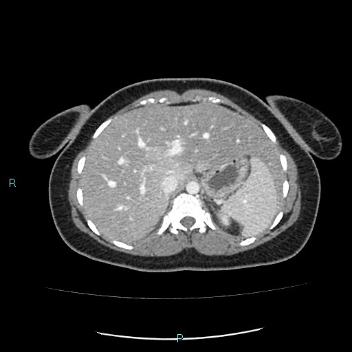 Acute bilateral pyelonephritis (Radiopaedia 37146-38881 Axial C+ portal venous phase 21).jpg