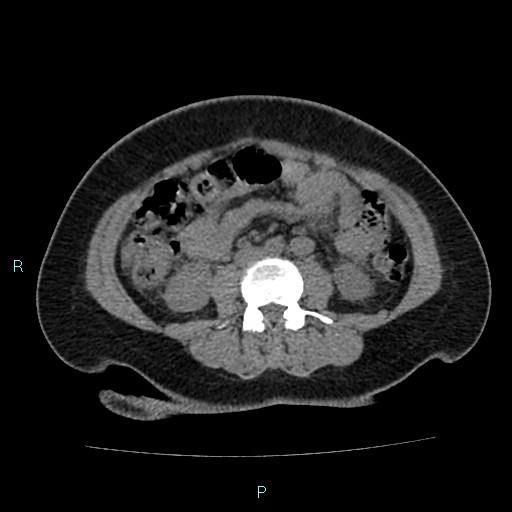 File:Acute bilateral pyelonephritis (Radiopaedia 37146-38881 Axial non-contrast 57).jpg