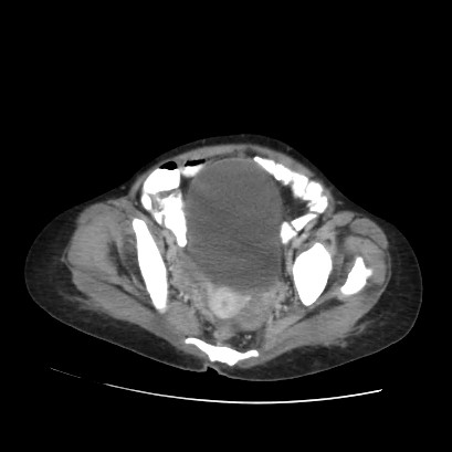 Acute calculous cholecystitis in patient with osteopetrosis (Radiopaedia 77871-90159 Axial C+ portal venous phase 69).jpg