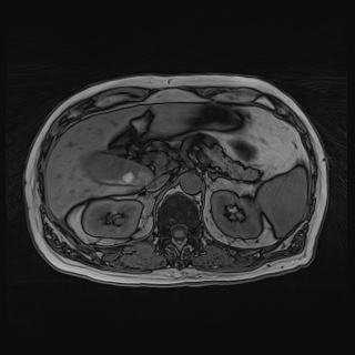 File:Acute cholecystitis (Radiopaedia 72392-82923 Axial T1 out-of-phase 50).jpg