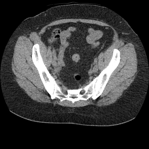 File:Acute cholecystitis and ureteric colic (Radiopaedia 42330-45444 Axial prone 88).jpg