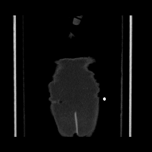 Acute cholecystitis with tensile fundus sign (Radiopaedia 71394-81723 Coronal non-contrast 129).jpg
