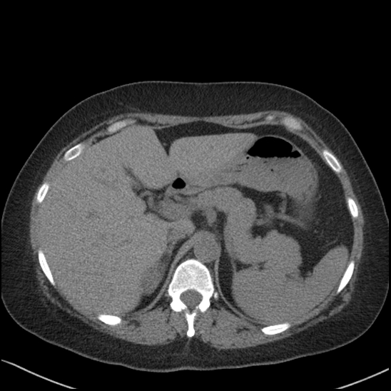 Acute colonic hemorrhage in ulcerative colitis (Radiopaedia 77415-89538 Axial non-contrast 33).jpg