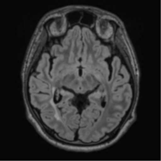 Acute disseminated encephalomyelitis (ADEM)- Anti-NMDA receptor encephalitis (Radiopaedia 54920-61201 Axial FLAIR 30).png