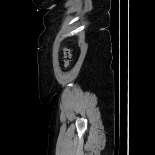 Acute diverticulitis - transverse colon (Radiopaedia 87063-103327 Sagittal C+ portal venous phase 192).jpg