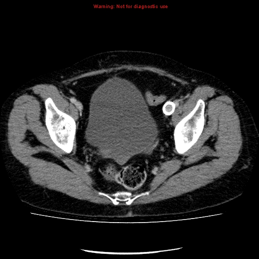 Acute gangrenous cholecystitis (Radiopaedia 10123-10661 Axial C+ portal venous phase 90).jpg
