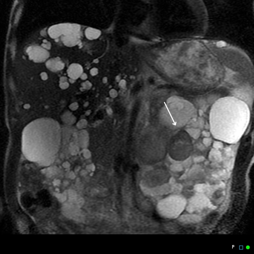 File:Acute hemorrhage in a renal cyst in polycystic disease (MRI) (Radiopaedia 41702-44642 Coronal T2 fat sat 1).jpg