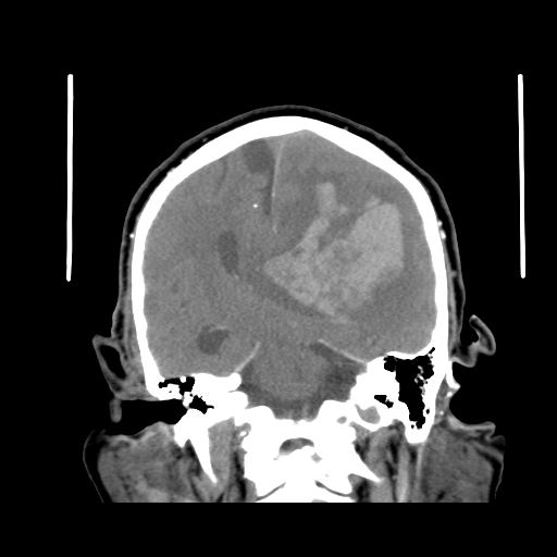 Acute hemorrhagic stroke (Radiopaedia 17507-17223 Coronal non-contrast 31).jpg