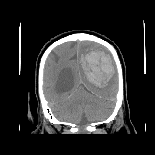 File:Acute hemorrhagic stroke (Radiopaedia 17507-17223 Coronal non-contrast 40).jpg