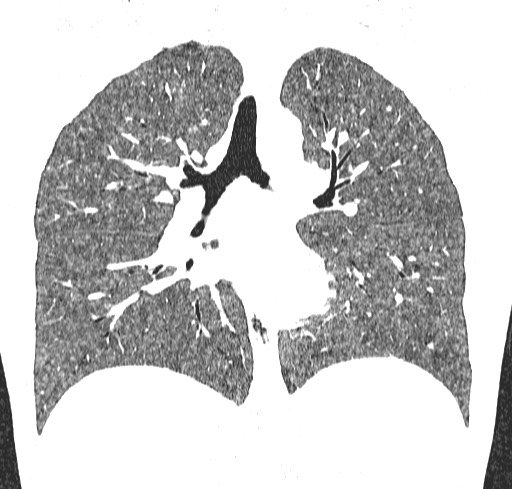 Acute hypersensitivity pneumonitis (Radiopaedia 85293-100870 Coronal lung window 71).jpg
