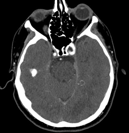 File:Acute internal carotid artery dissection (Radiopaedia 53541-59630 Axial C+ arterial phase 22).jpg