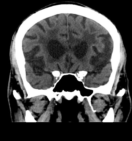 Acute left anterior cerebral artery territory infarction (Radiopaedia 51785-57578 Coronal non-contrast 22).jpg