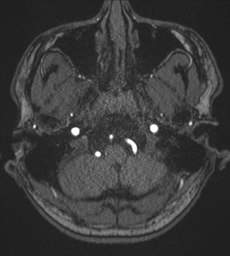Acute left middle cerebral artery territory infarct with clot retrieval (Radiopaedia 47732-52433 Axial MRA 6).png
