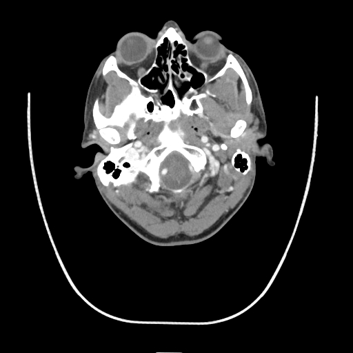 Acute longus colli calcific tendinitis (Radiopaedia 72495-83036 Axial C+ arterial phase 10).jpg