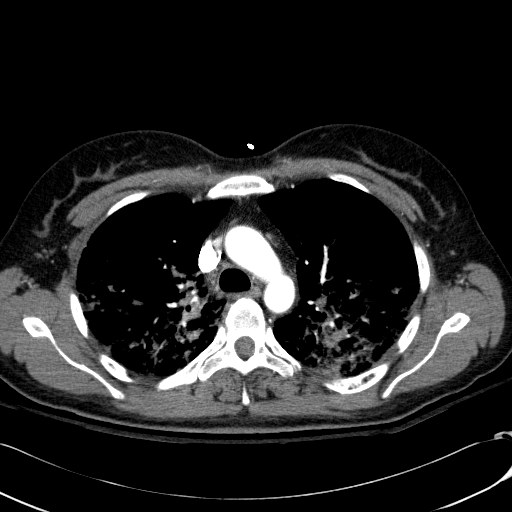 File:Acute myocardial infarction in CT (Radiopaedia 39947-42415 Axial C+ arterial phase 41).jpg