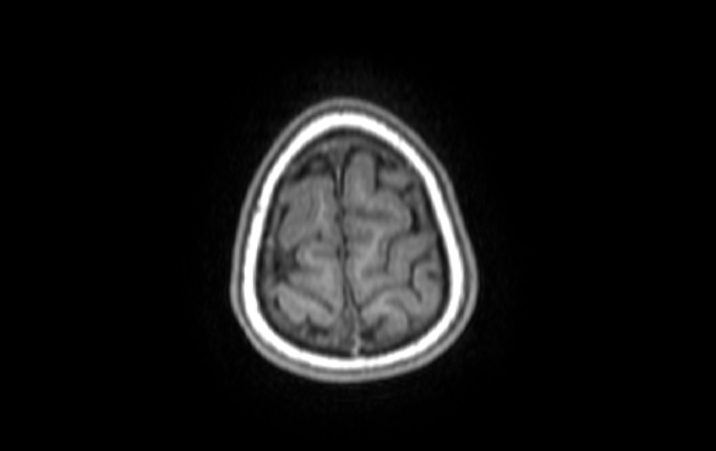 Acute necrotizing encephalitis of childhood (Radiopaedia 67356-76737 Axial T1 7).jpg