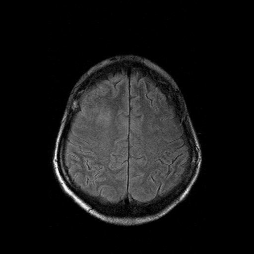 File:Acute necrotizing toxoplasma encephalitis (Radiopaedia 10683-11149 Axial FLAIR 4).jpg