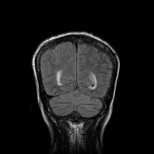 File:Acute necrotizing toxoplasma encephalitis (Radiopaedia 10683-11149 Coronal FLAIR 4).jpg