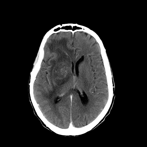 File:Acute necrotizing toxoplasma encephalitis (Radiopaedia 10683-11150 C+ arterial phase 15).jpg