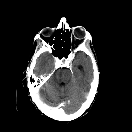 File:Acute necrotizing toxoplasma encephalitis (Radiopaedia 10683-11150 C+ arterial phase 22).jpg