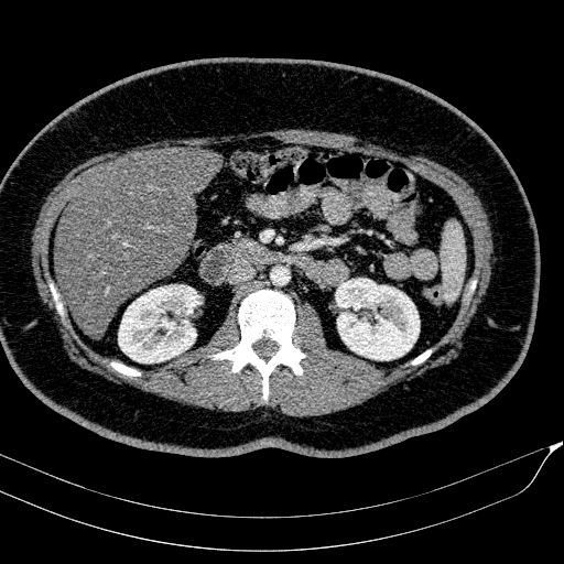 Acute on chronic pancreatitis (Radiopaedia 80902-94423 Axial C+ portal venous phase 78).jpg