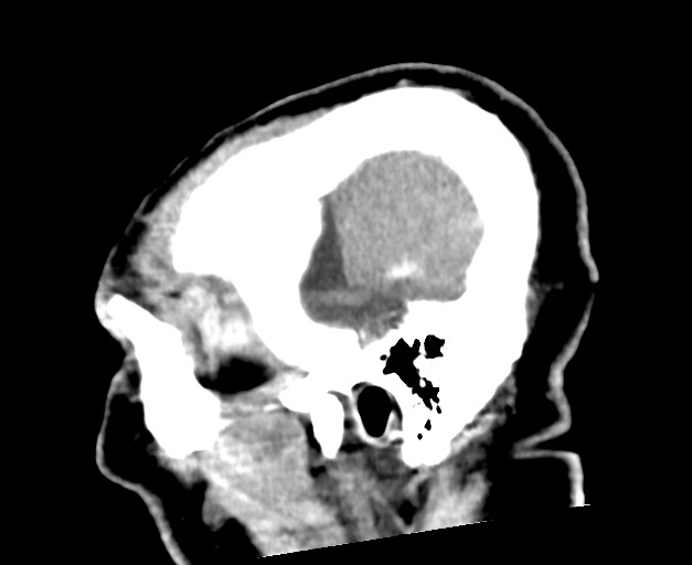 Acute on chronic subdural hematoma (Radiopaedia 78346-90966 Sagittal non-contrast 49).jpg